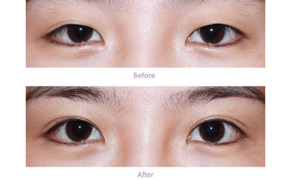 微創(chuàng)雙眼皮手術的優(yōu)點是什么?微創(chuàng)雙眼皮適合所有人嗎?