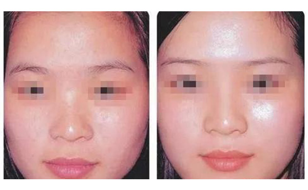 水光注射疼不疼？