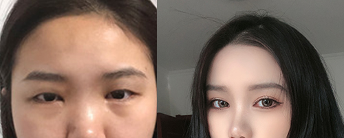 蘭州亞韓做雙眼皮案例對比圖3