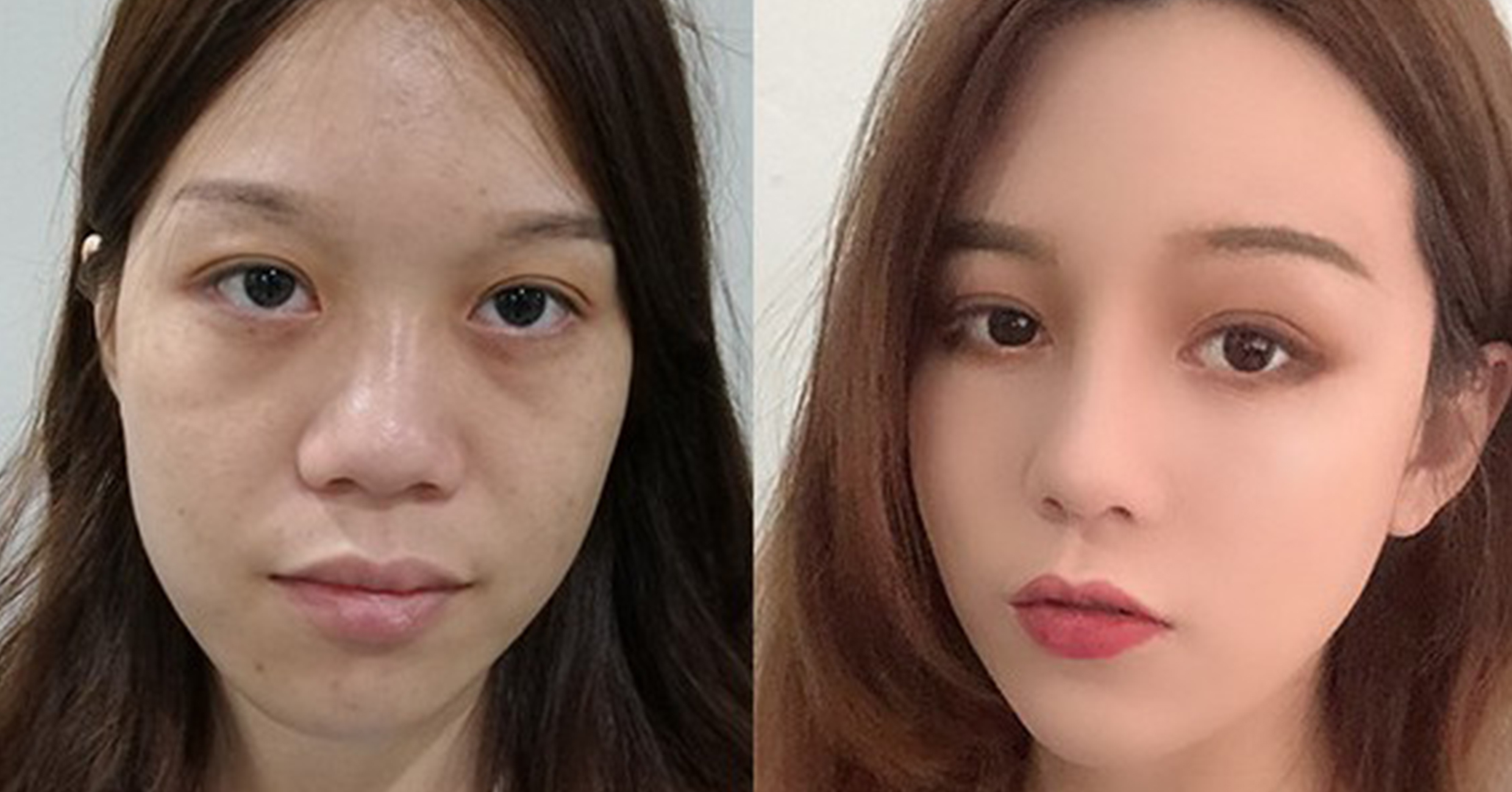 脂肪填充手術(shù)效果對(duì)比2