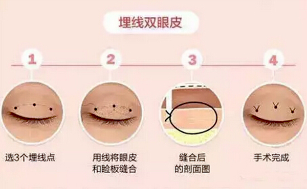 全切雙眼皮跟埋線的區(qū)別是什么？哪個好？