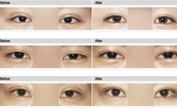 雙眼皮手術(shù)失敗如何修復呢?需要多長時間?