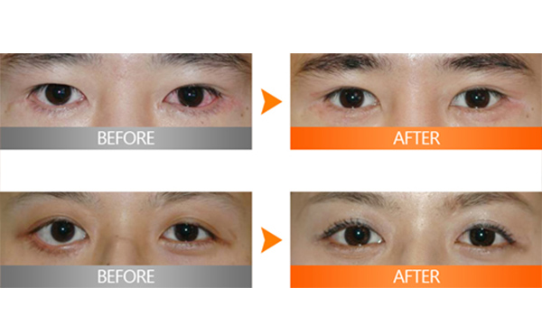 埋線雙眼皮失敗該如何修復(fù)？多久修復(fù)好？