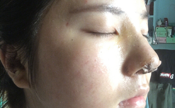 為什么鼻綜合整形比單純隆鼻效果好?