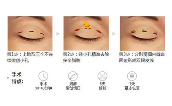 韓式三點(diǎn)雙眼皮的手術(shù)過程是什么?術(shù)后怎么避免疤痕增生?