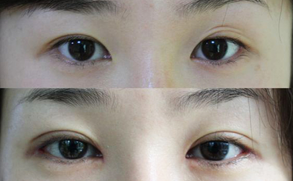 哪個季節(jié)做雙眼皮好?術后有什么需要注意的?