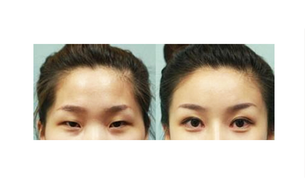 先天性小眼癥怎么矯正?有哪些注意事項(xiàng)?