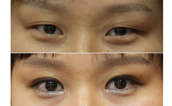 哪些人不能做小眼矯正?矯正術(shù)前有什么注意事項?