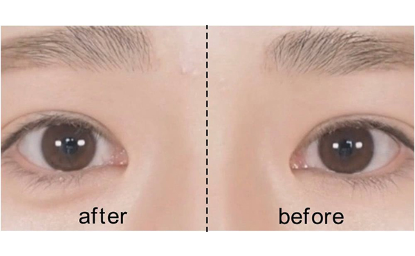 玻尿酸豐臥蠶術后怎么護理?哪些人不適合玻尿酸豐臥蠶?