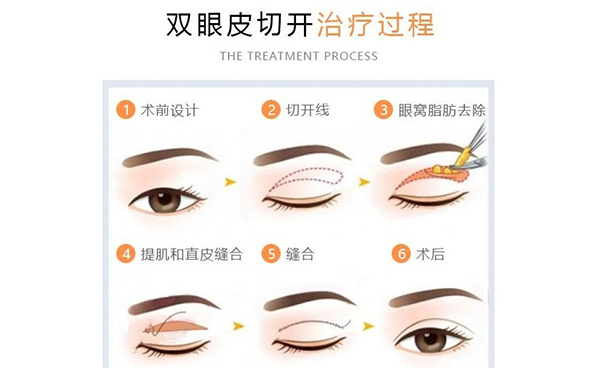 割雙眼皮改善腫眼泡有什么優(yōu)勢?術(shù)后有什么并發(fā)癥?
