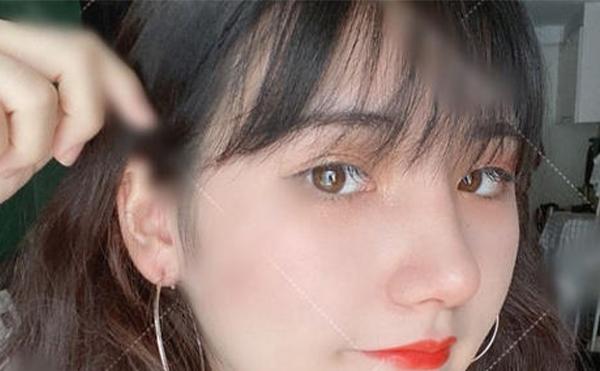 假體取出來鼻子會變形嗎?