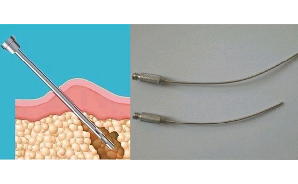 面部吸脂效果怎么樣?術(shù)后會(huì)不會(huì)留疤?