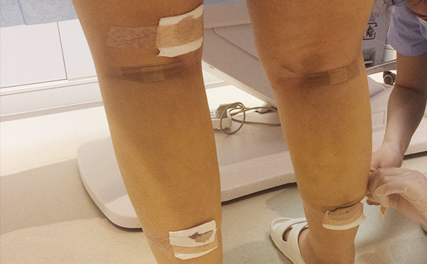 腿部吸脂的部位有哪些？