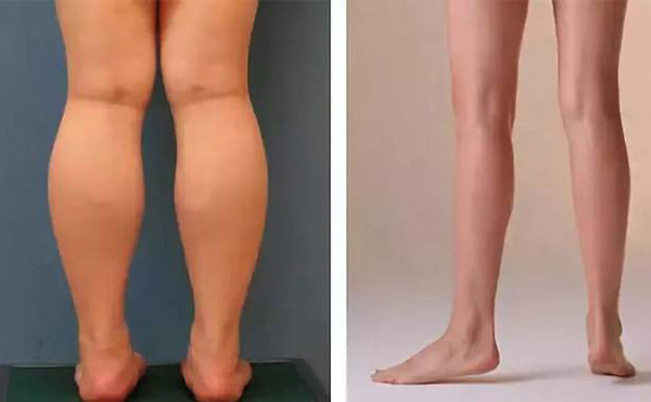 腿部吸脂疼不疼？