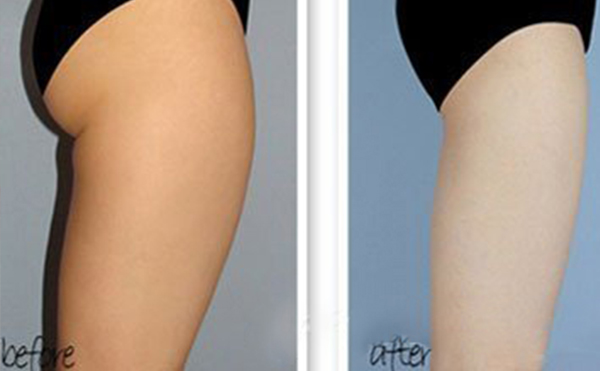 哪些人適合做臀部抽脂？