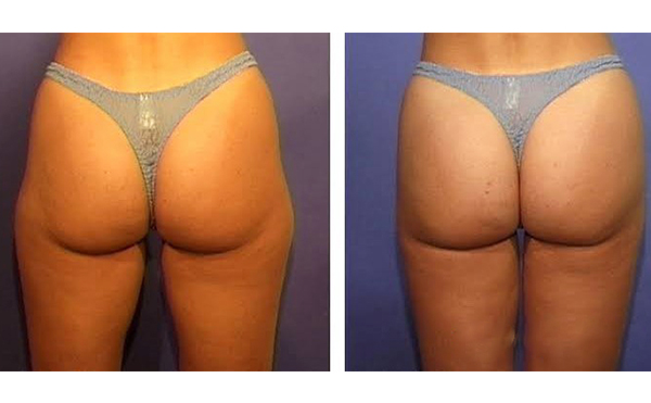 臀部吸脂一次最多能吸多少?術后需要多久恢復?