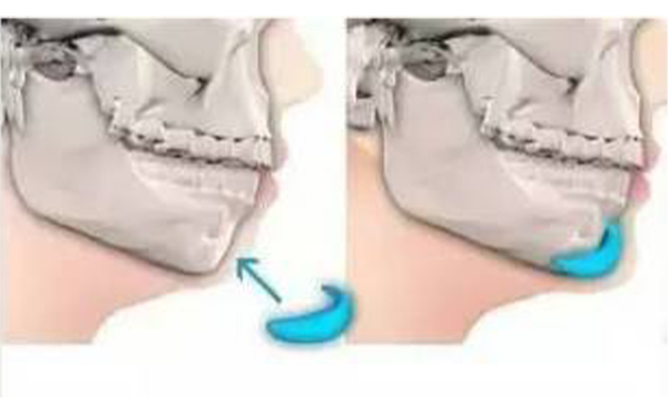 假體墊下巴術(shù)后怎樣護(hù)理?術(shù)后效果不滿意可以取出假體嗎?