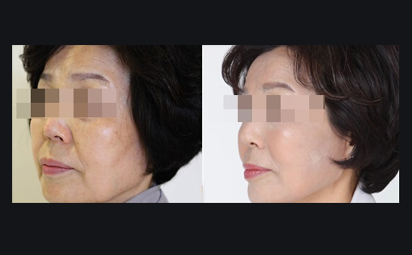 電波拉皮適合哪些人？