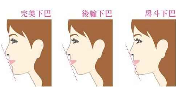 巴整形貴不貴?整形下巴一般要多少錢?