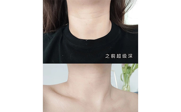 激光去頸紋適合哪些人？