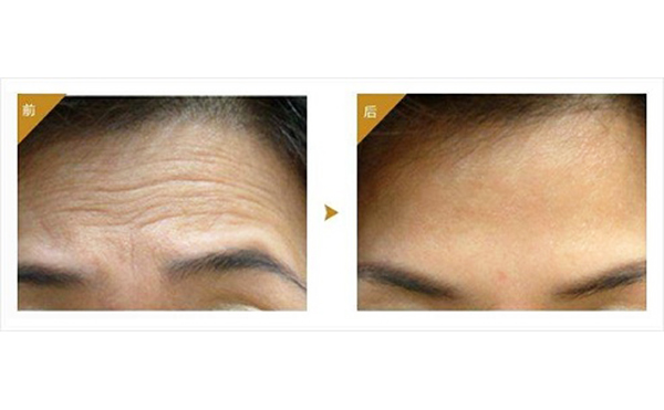 注射玻尿酸注意事項(xiàng)有哪些？