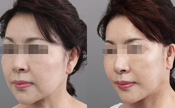 膠原蛋白除皺安全嗎?有沒有副作用?