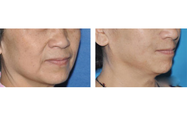 筋膜懸吊除皺適合哪些人？