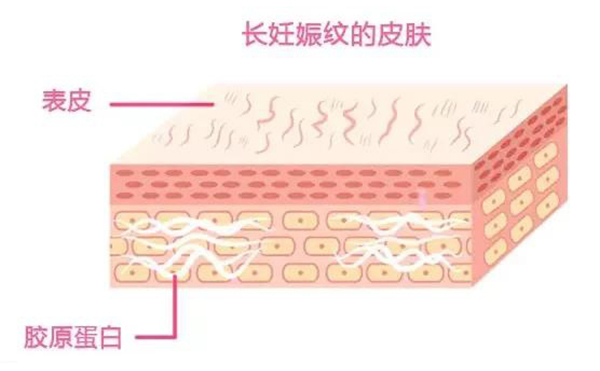 妊娠紋是怎么形成的？