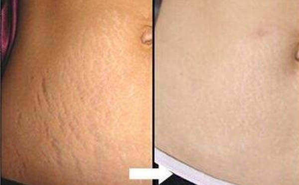 激光去妊娠紋幾次見效？