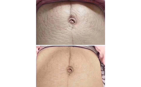 激光去妊辰紋多少錢？