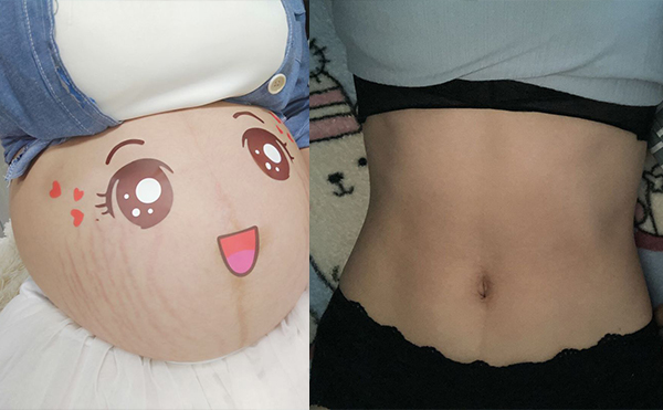 電波拉皮去除妊娠紋效果怎么樣？