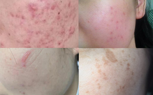 光子嫩膚安全嗎？