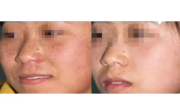 彩光嫩膚的效果怎么樣？