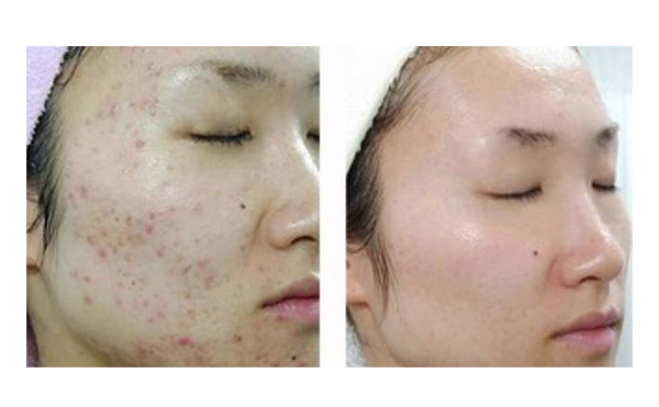 果酸煥膚多久做一次？