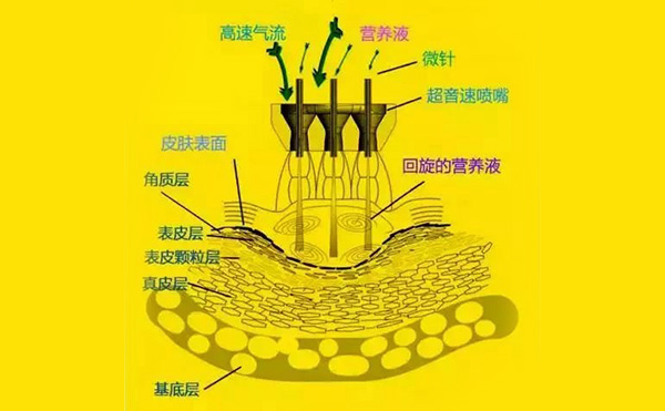  無針?biāo)忉樖窃趺醋龅?效果怎么樣?