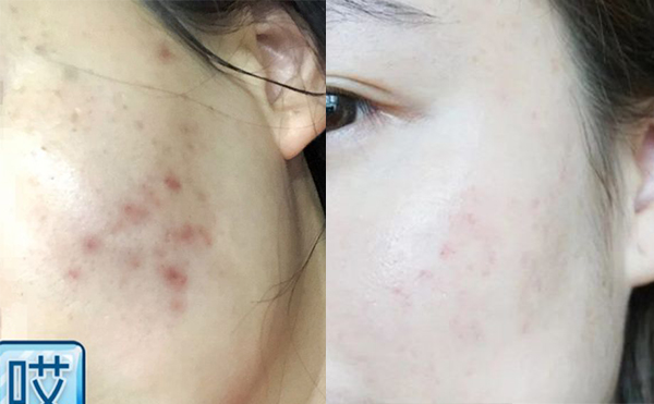 激光美白能安全嗎？