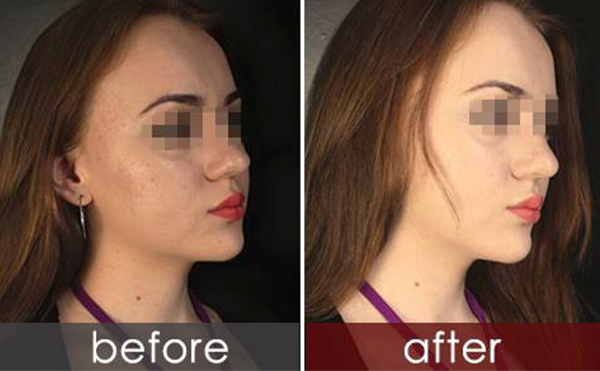 白瓷娃娃有什么風險?怎么預防?