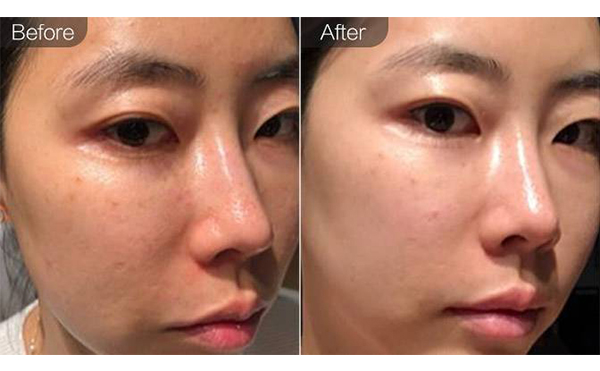 e光嫩膚是什么？