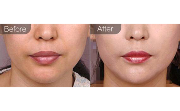 e光嫩膚有什么優(yōu)勢？