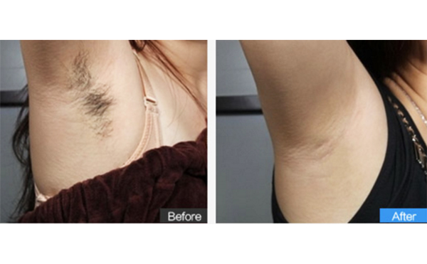 激光脫腋毛后多久能見效？