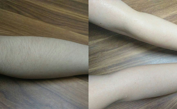 冰點手臂脫毛會傷害皮膚嗎？