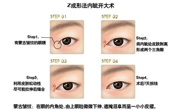 開內(nèi)眼角復(fù)雜嗎?手術(shù)過程是什么?