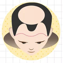 六級(jí)脫發(fā)