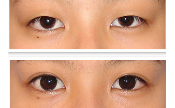 埋線雙眼皮去腫眼泡多久能消腫?有什么注意事項?