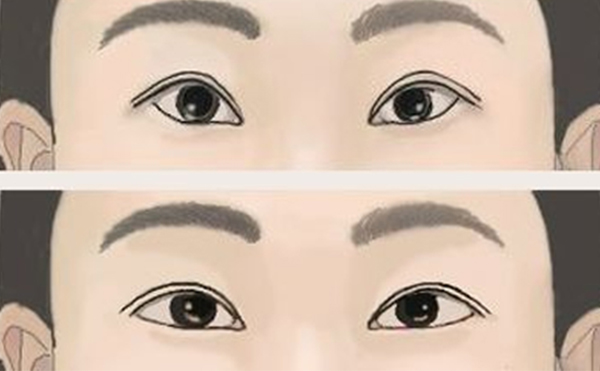 倒三角眼怎么改善?有什么注意事項?