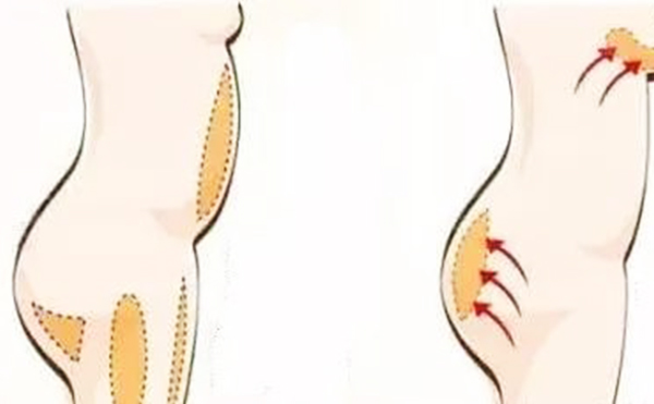 自體脂肪豐臀有哪些方法?手術(shù)過程是什么?
