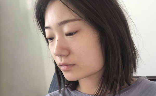 下頜角整形適宜人群有哪些？