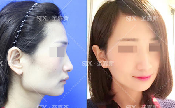 下頜角整形后皮膚是否會(huì)松弛？