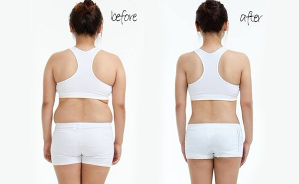 背部吸脂手術(shù)疼不疼？