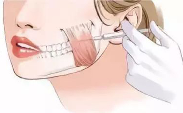 哪些小習(xí)慣會(huì)導(dǎo)致咬肌肥大？咬肌肥大怎么辦？